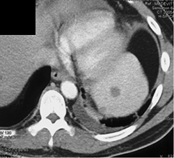 Sarcoidosis - CTisus CT Scan