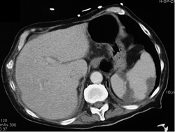 Splenic Infarcts - CTisus CT Scan