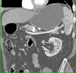 Splenic Infarcts - CTisus CT Scan