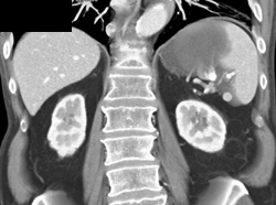 Normal Spleen and Splenic Artery - CTisus CT Scan