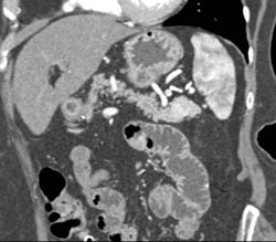 Moire Enhancement of the Spleen - CTisus CT Scan