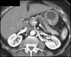 Pancreatic Mass Was Intrapancreatic Splenic Tissue - CTisus CT Scan