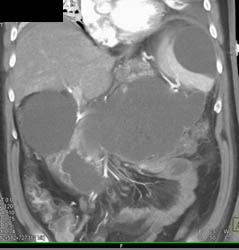 Pseudocysts With Subcapsular Collection Spleen - CTisus CT Scan