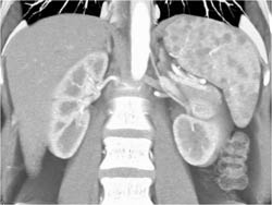 Sarcoidosis - CTisus CT Scan