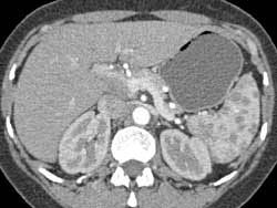 Sarcoidosis - CTisus CT Scan