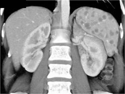 Sarcoidosis - CTisus CT Scan