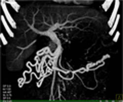 Splenic Vein Occlusion and Extensive Collaterals - CTisus CT Scan