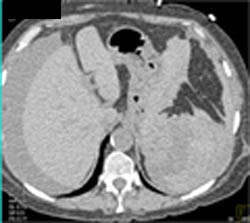 Splenic Laceration and Bleed on Non Contrast Ct - CTisus CT Scan