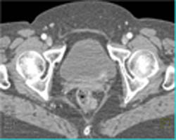 Splenosis - CTisus CT Scan