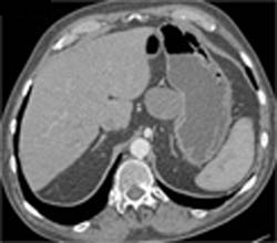 Splenic Artery Aneurysm Simulates A Duplication Cyst - CTisus CT Scan