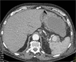 Pseudoaneurysm S/P Pancreatitis - CTisus CT Scan