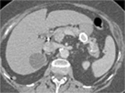 Calcified Splenic Artery Aneurysm - CTisus CT Scan