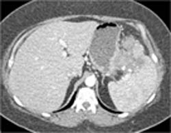 Pancreatic Cancer Infiltrates/invades the Spleen - CTisus CT Scan