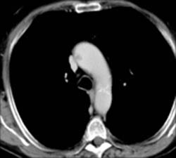 Clot in Aorta With Splenic Infarct - CTisus CT Scan