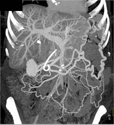 Occluded Splenic Vein With Collaterals - CTisus CT Scan