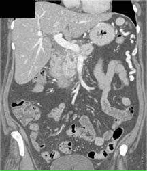 Accessory Spleen Also Noted - CTisus CT Scan