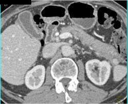 Accessory Spleen Simulates An Islet Cell Tumor of the Pancreatic Tail - CTisus CT Scan