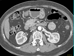 Unusually Positioned Accessory Splenic Tissue - CTisus CT Scan