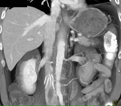 Splenic Infarcts - CTisus CT Scan