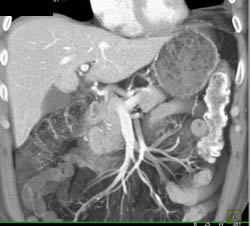 Splenic Infarcts - CTisus CT Scan