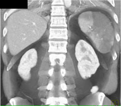 Splenic Infarcts - CTisus CT Scan