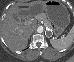 Splenic Artery Aneurysm Simulates An Adrenal Mass - CTisus CT Scan