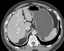 Splenic Hemangioma - CTisus CT Scan