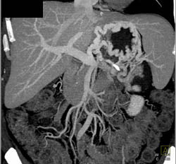 Gastric Varices With Splenic Vein Occlusion - CTisus CT Scan