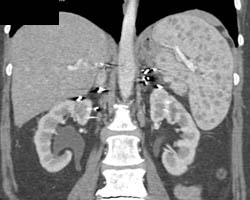 Sarcoidosis - CTisus CT Scan