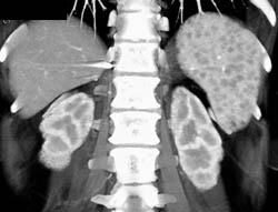 Sarcoidosis - CTisus CT Scan