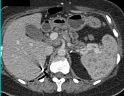 Sarcoidosis - CTisus CT Scan