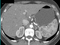 Sarcoidosis - CTisus CT Scan