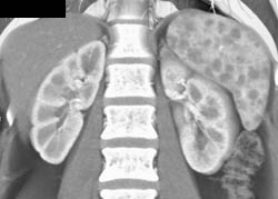 Sarcoidosis - CTisus CT Scan