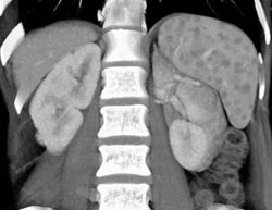 Sarcoidosis - CTisus CT Scan