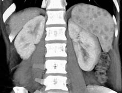 Sarcoidosis - CTisus CT Scan