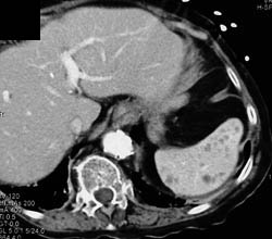 Splenic Hemangioma in Klippel-Trenaunay-Weber (KTW) Syndrome - CTisus CT Scan