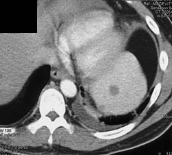 Splenic Cyst - CTisus CT Scan