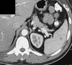 Splenic Abscess in An Immunosuppressed Patient - CTisus CT Scan