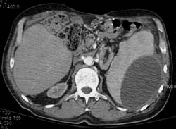 Old Subcapsular Hematoma - CTisus CT Scan