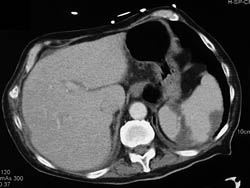 Splenic Infarcts - CTisus CT Scan