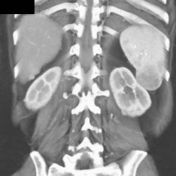 Splenic Lymphoma - CTisus CT Scan