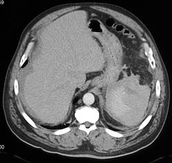 Splenic Rupture With Active Bleed and Hemoperitoneum - CTisus CT Scan