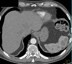 Sarcoidosis - CTisus CT Scan