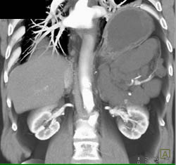 Lymphangioma Pushes on Spleen - CTisus CT Scan