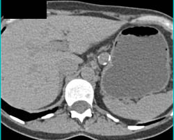 Splenic Artery Aneurysm - CTisus CT Scan