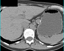 Splenic Artery Aneurysm - CTisus CT Scan