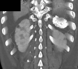 Sickle Cell Disease - CTisus CT Scan