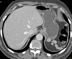 Accessory Spleens and Splenosis - CTisus CT Scan