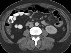 Splenic Artery Pseudoaneurysm - CTisus CT Scan