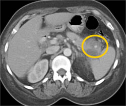 Splenic Artery Pseudoaneurysm - CTisus CT Scan